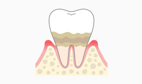 軽度歯周炎
