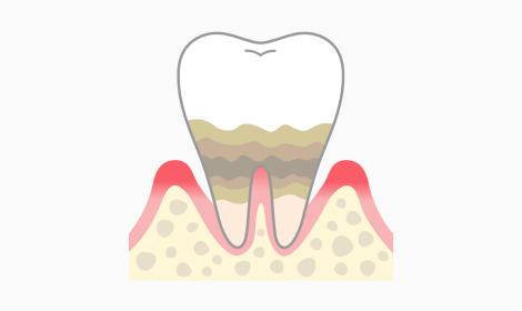 重度歯周炎