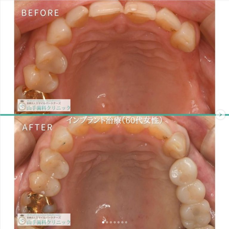 症例紹介１：インプラント治療（60代女性）