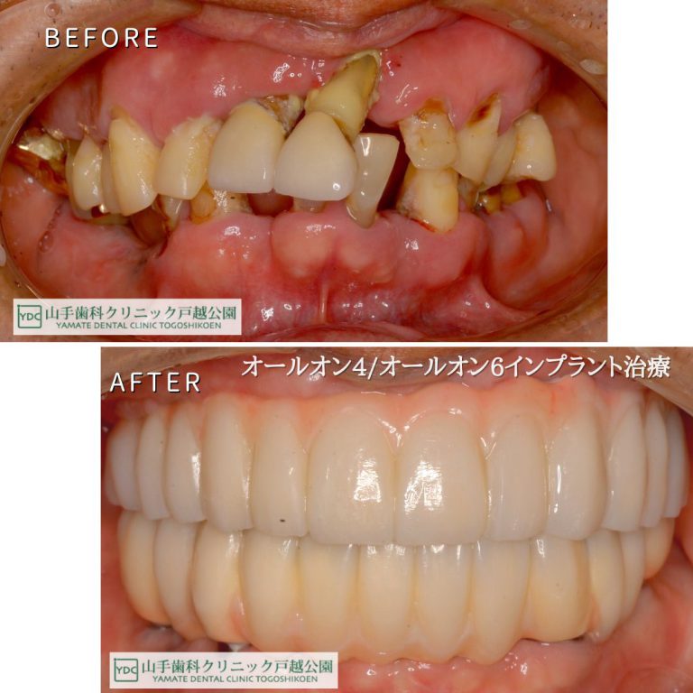 症例紹介２：インプラント治療（70代男性）