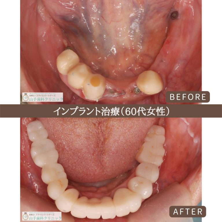 症例紹介4：インプラント治療（60代女性）