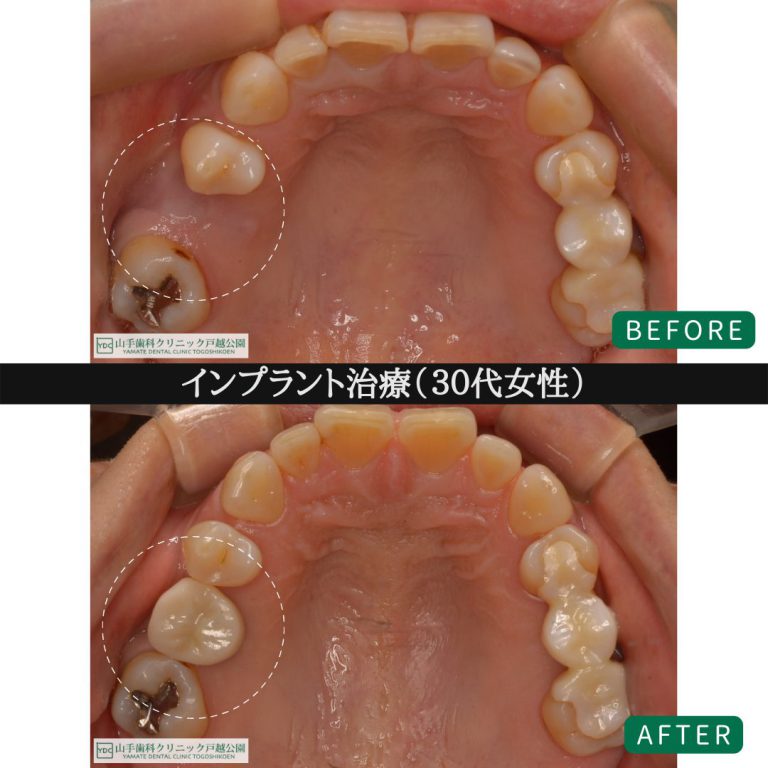 症例紹介5：インプラント治療（30代女性）