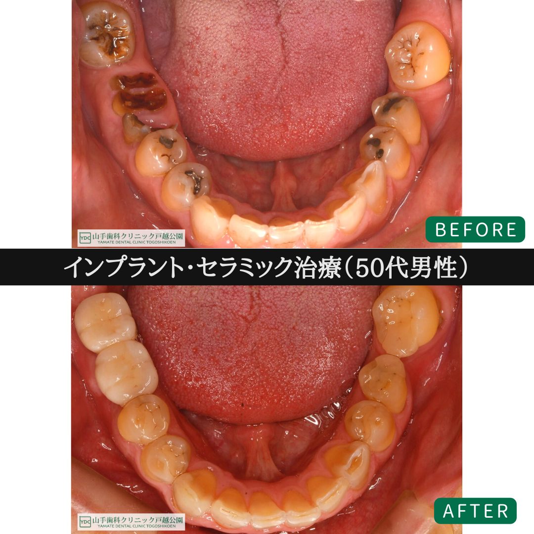 症例紹介6：インプラント・セラミック治療（50代男性）