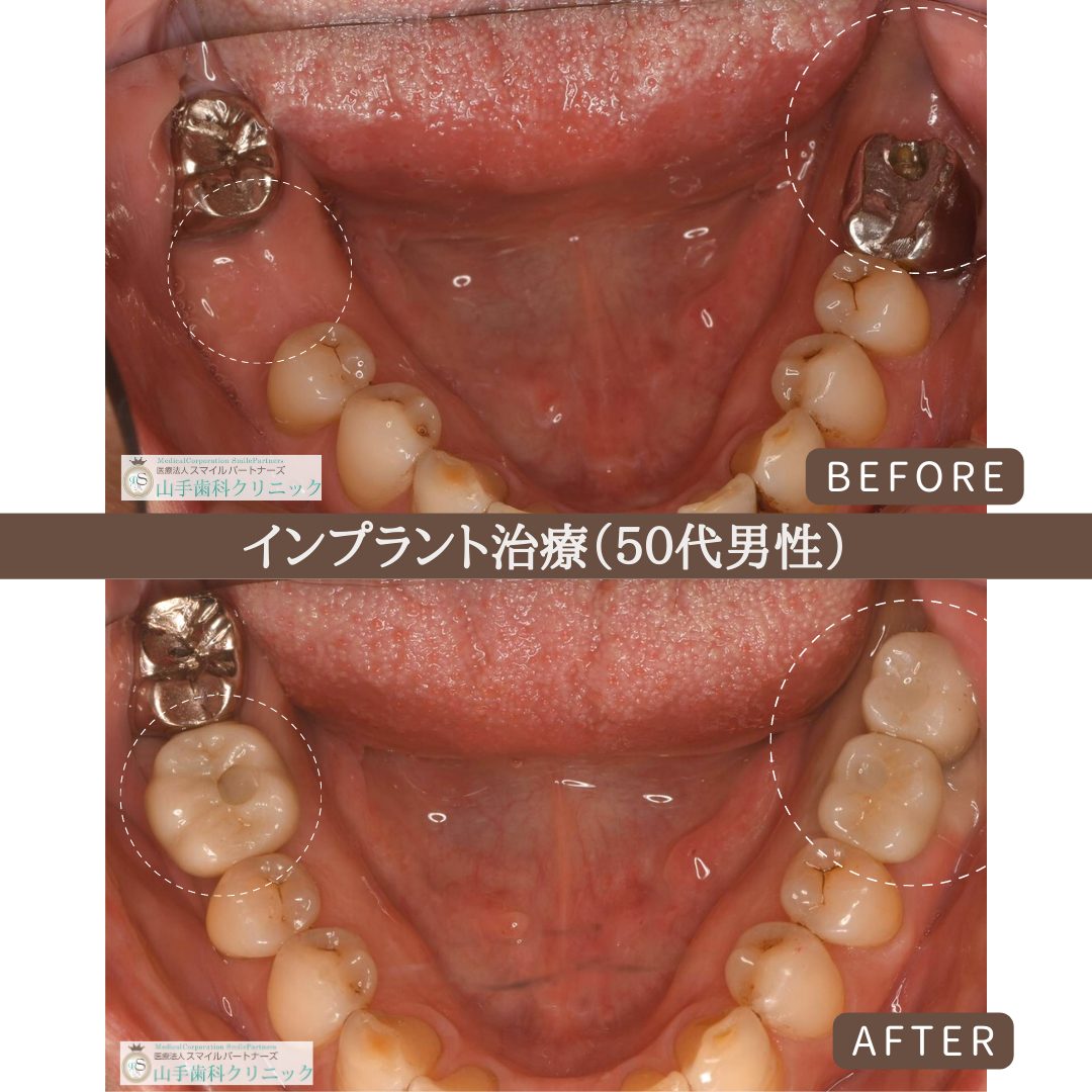 症例紹介7：インプラント治療（50代男性）