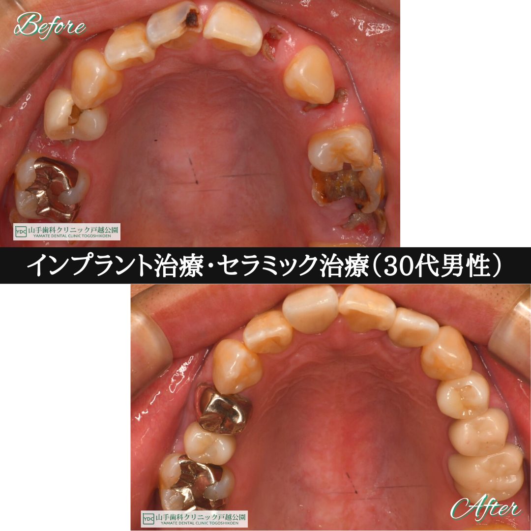 症例紹介16：インプラント治療・セラミック治療（30代男性）