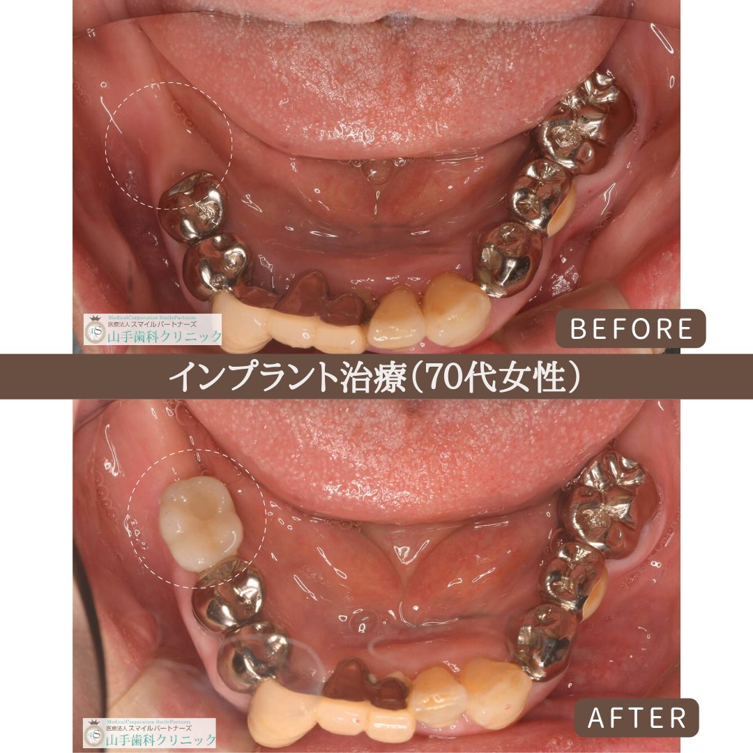 症例紹介9：インプラント治療（70代女性）