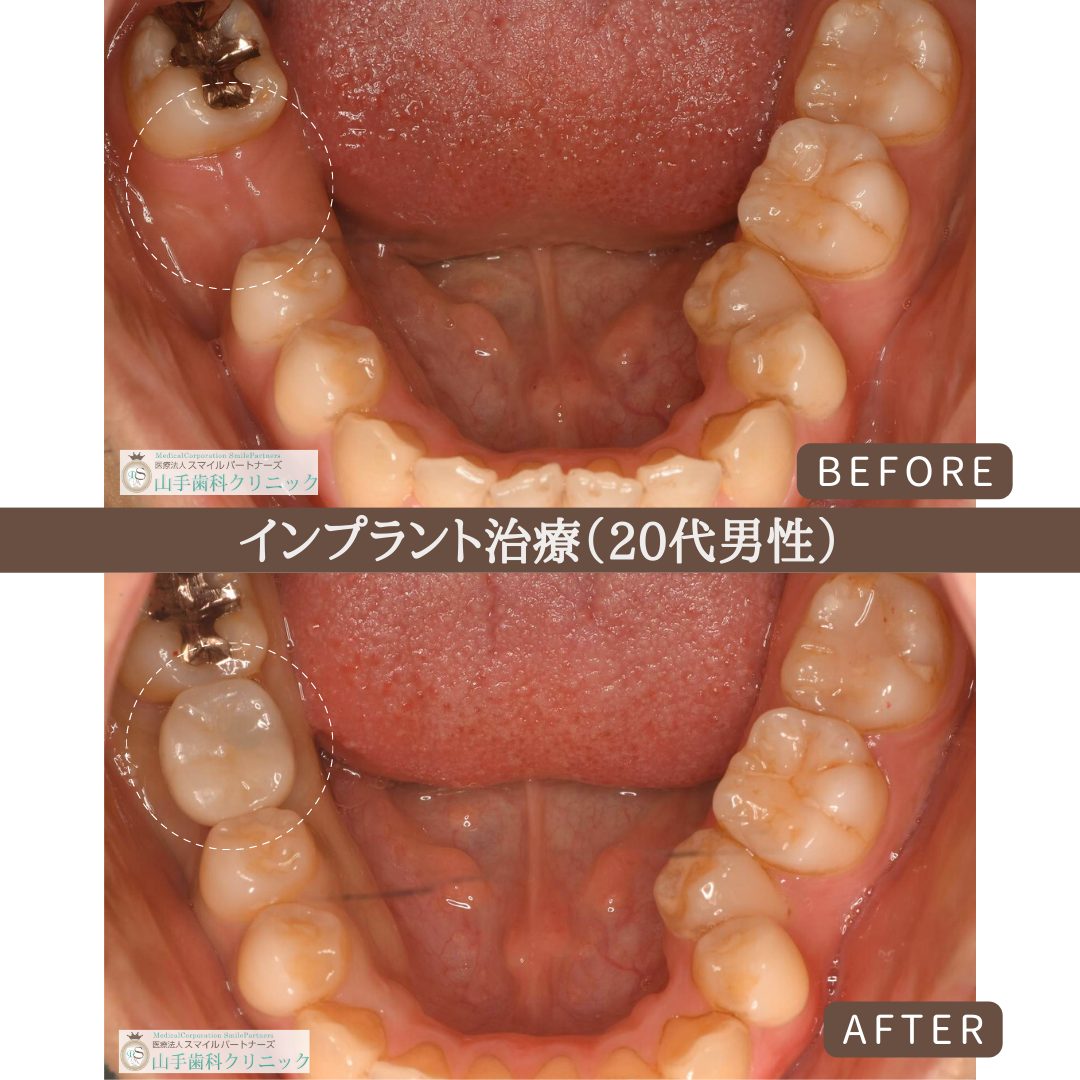 症例紹介11：インプラント治療（20代男性）