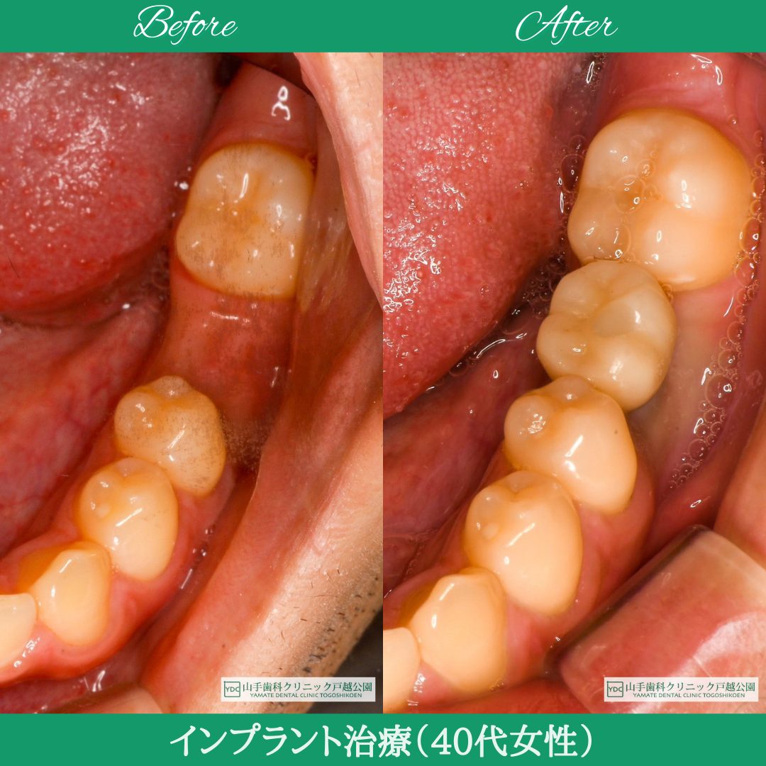 症例紹介14：インプラント治療（20代男性）